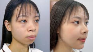 Hô xương có niềng được không? Giải đáp từ bác sĩ chuyên khoa Răng Hàm Mặt