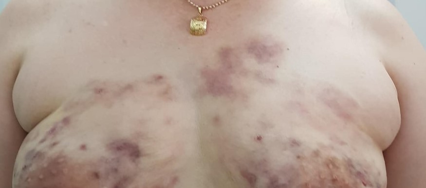 Trường hợp khách hàng bị hoại tử khi thực hiện tại cơ sở kém chất lượng