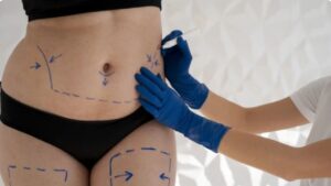 Hút mỡ bị đau kéo dài: 5 nguyên nhân gây đau kéo dài và cách xử lý y khoa