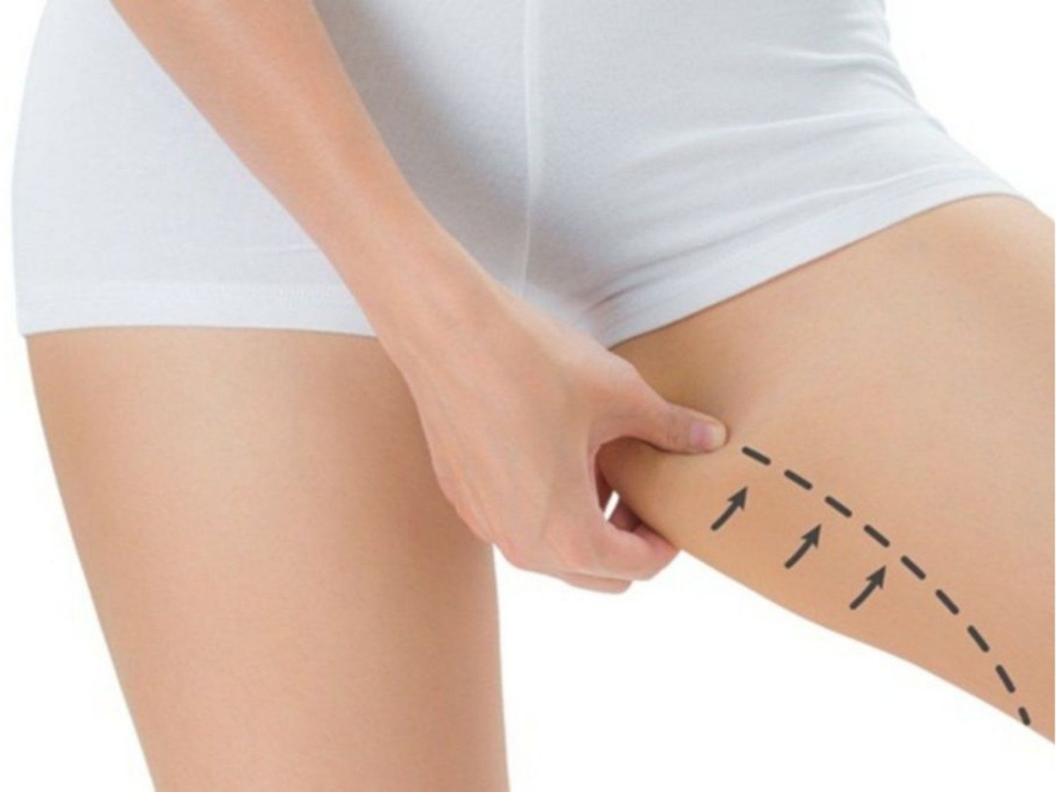 Hút mỡ bị tê da là phản ứng do tổn thương thần kinh nông dưới da