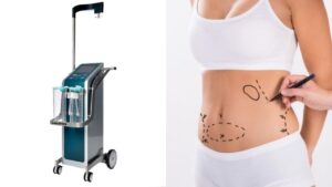 Công nghệ hút mỡ Body Jet là gì? Giải pháp hút mỡ tia nước ít sưng đau, bảo tồn tế bào mỡ sống