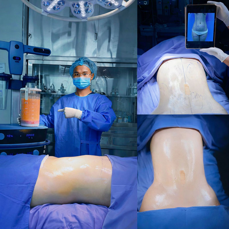 Công nghệ hút mỡ hiện đại hóa lỏng mỡ có chọn lọc, đảm bảo hiệu quả