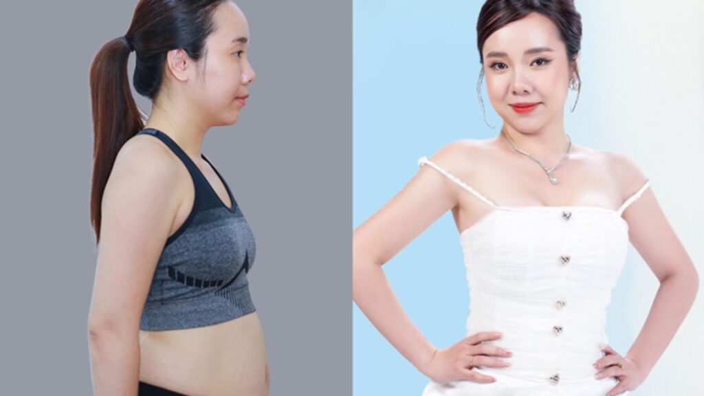 Hút mỡ xong bao lâu thì đẹp? Mốc 1-3-6 tháng hồi phục