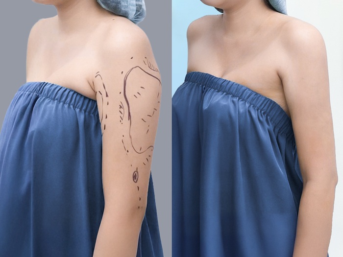 Vùng bắp tay nhanh hồi phục sau khi hút mỡ, thon gọn và nhìn cân đối 