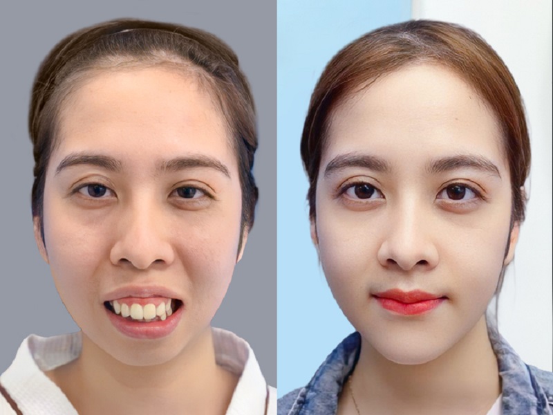 Kết quả chỉnh hàm hô của khách hàng tại Kangnam Hà Nội