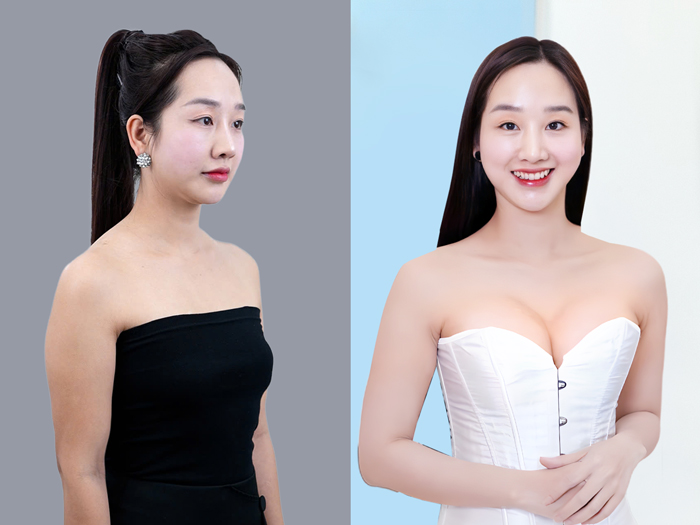 Khách hàng sở hữu vòng 1 to tròn, tự nhiên và cân đối sau nâng ngực