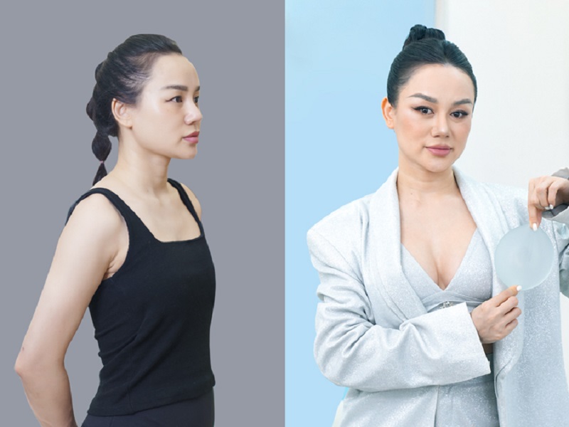 Khách hàng sở hữu vòng 1 to tròn, cân đối sau nâng ngực