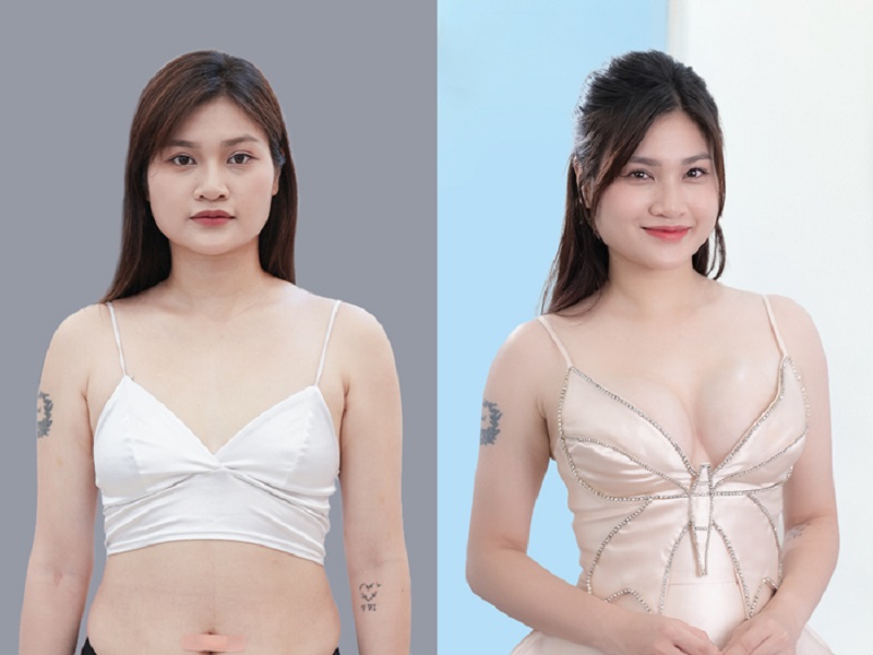 Sau 3 tháng ngực mềm mại, vào form tự nhiên
