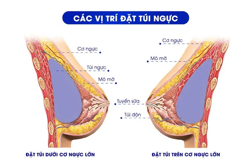 Ứng dụng đặt túi ngực dưới cơ ngực để không gây ảnh hưởng đến tuyến sữa và giảm thiểu bao xơ co thắt