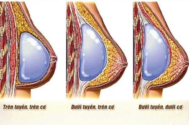 Đặt túi ngực dưới cơ sẽ không ảnh hưởng đến tuyến sữa