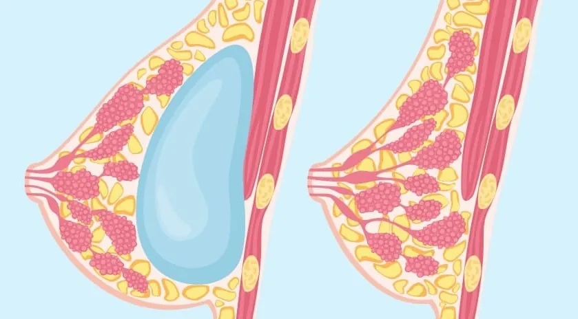 mô phỏng đặt túi ngực dưới cơ, người gầy áp dụng kỹ thuật này sẽ sở hữu bầu ngực tự nhiên