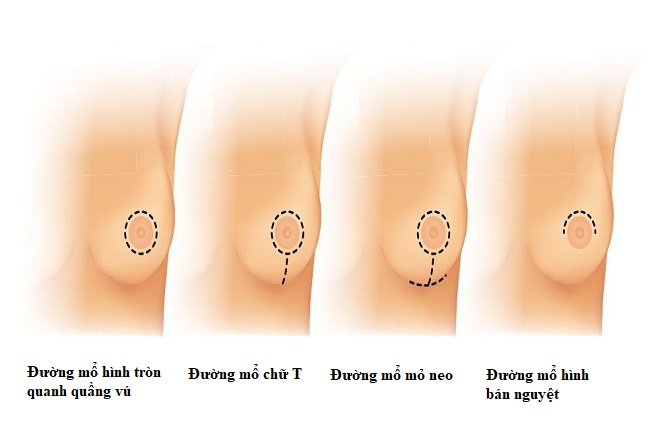 Các kỹ thuật mỏ treo ngực sa trễ phổ biến