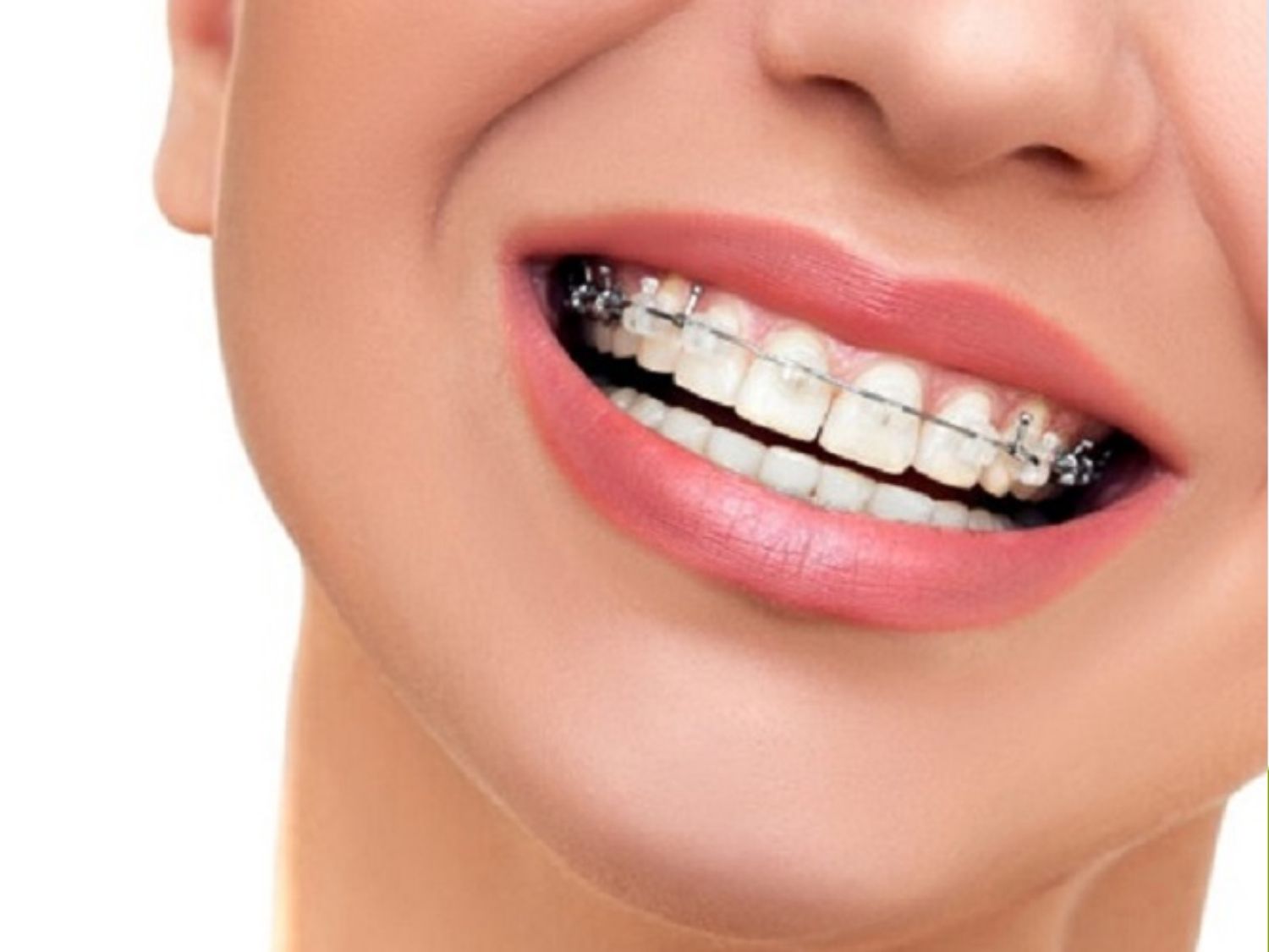 niềng răng có thể hết lệch mặt nếu do răng