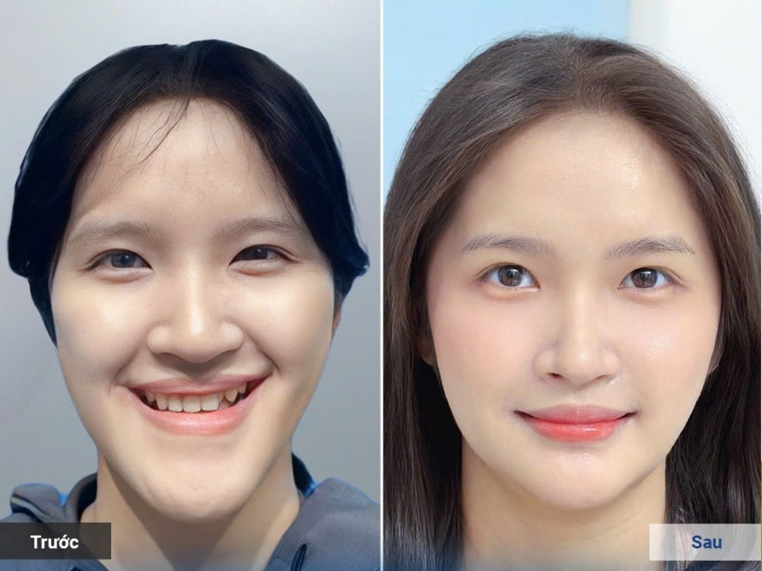 khách sau phẫu thuật hàm móm, lệch tại kangnam sở hữu khuôn hàm cân đối