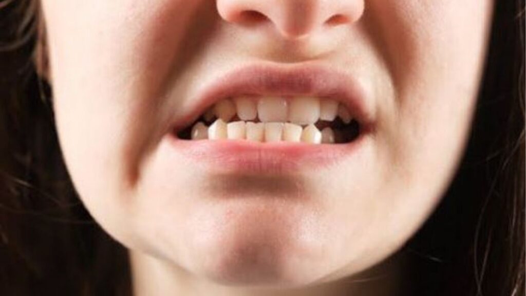 Lệch hàm có niềng được không? Phân tích rõ các trường hợp lệch hàm