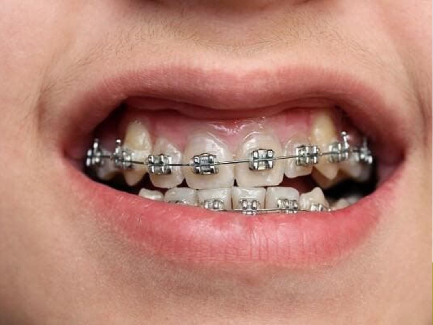 mặt lệch do răng có thể niềng răng cải thiện