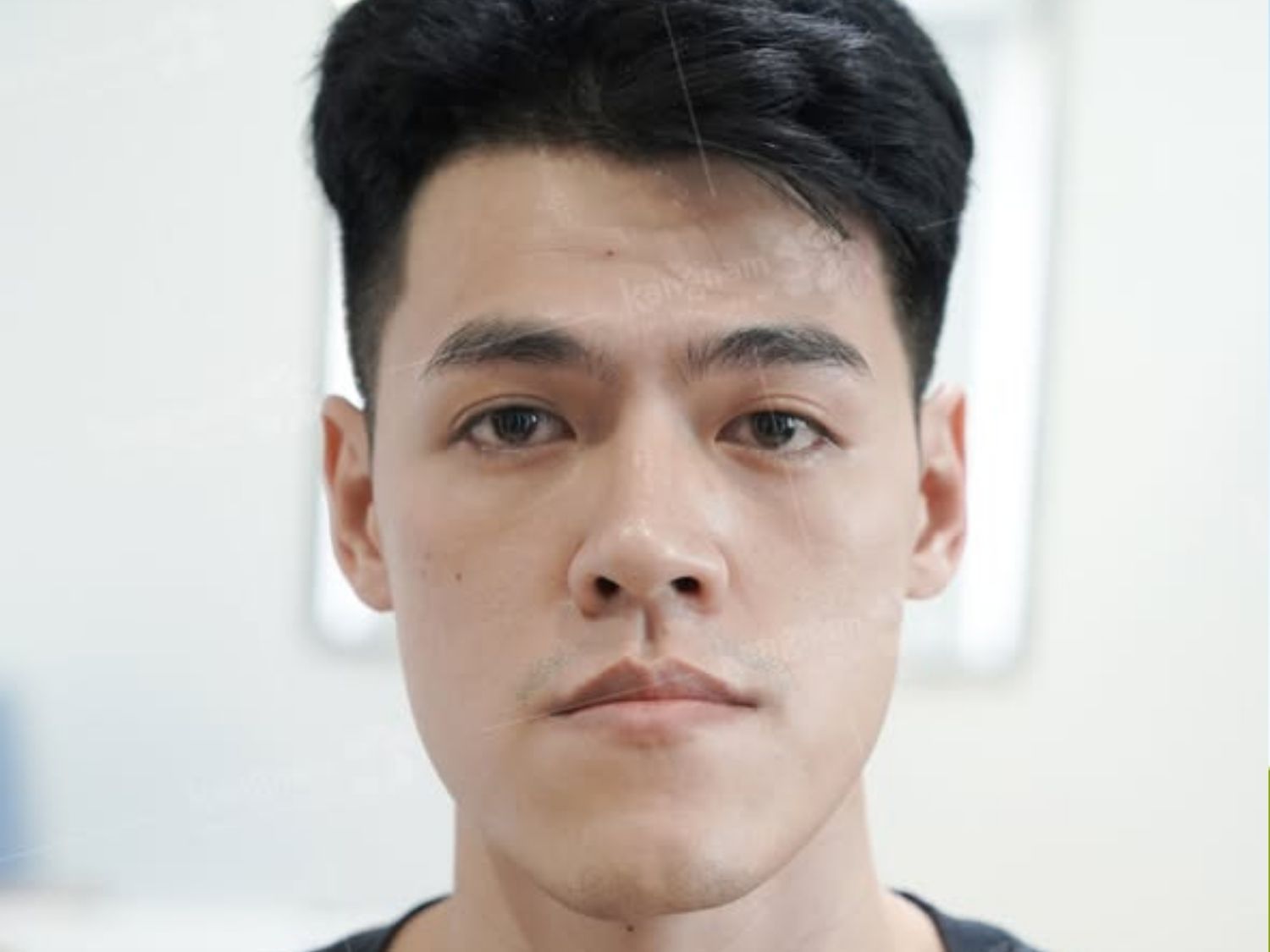 hàm lệch bẩm sinh