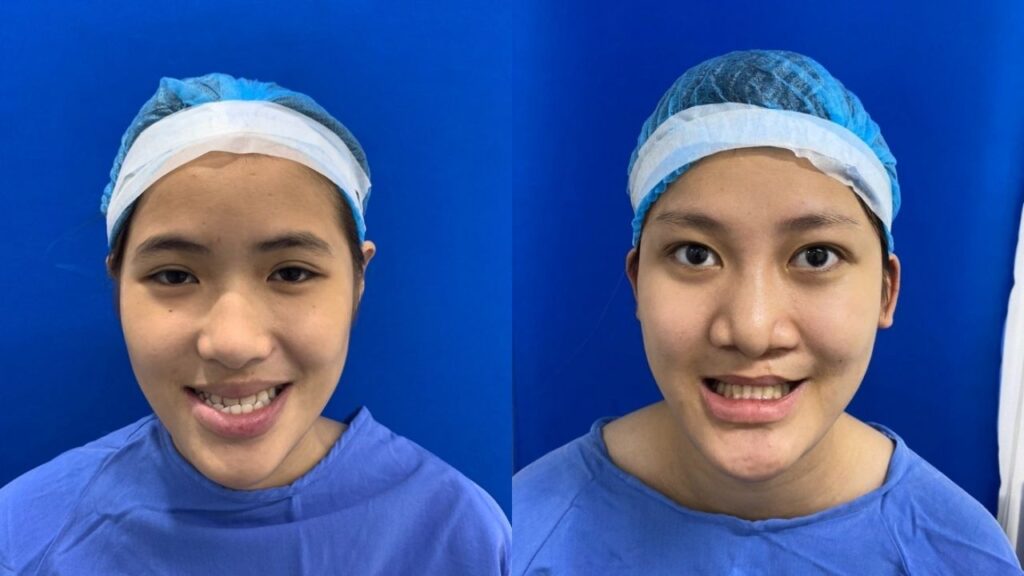 Lệch hàm do xương hay do răng? Giải pháp khắc phục hàm lệch triệt để