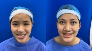 Lệch hàm do xương hay do răng? Giải pháp khắc phục hàm lệch triệt để