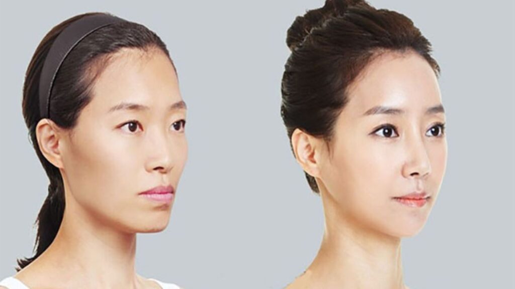 Mặt gò má cao nên làm gì? Cách khắc phục theo từng nguyên nhân và mức độ