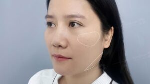 Gò má cao có nên hạ không? Sự thật về tướng Sát phu và giải pháp trẻ hóa diện mạo