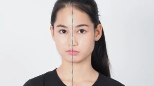 Mặt lệch nhẹ có cần phẫu thuật không? Khi nào chỉ cần niềng hoặc điều trị không mổ