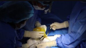 Bao xơ có phải mổ lại không? Phác đồ xử lý theo phân độ Baker và thời điểm cần thay túi