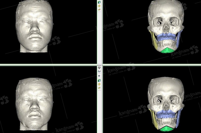 Công nghệ hình ảnh mô phỏng AI face giúp xác định chính xác vị trí dây thần kinh và lượng xương cần cắt bỏ.