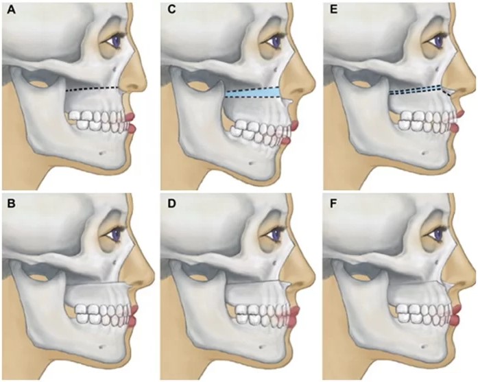 Kỹ thuật cắt xương chỉnh hàm hô, móm an toàn