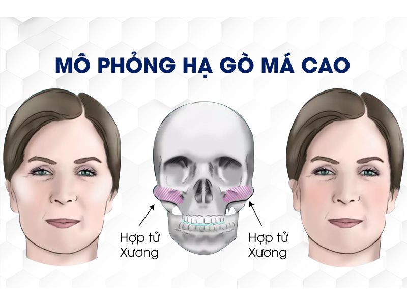 Mô phỏng kỹ thuật cắt xương tiêu chuẩn vàng trong hạ gò má hiện nay.