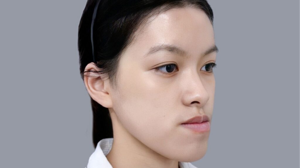 Móm nên niềng hay phẫu thuật? Phân biệt rõ để chọn đúng phương pháp