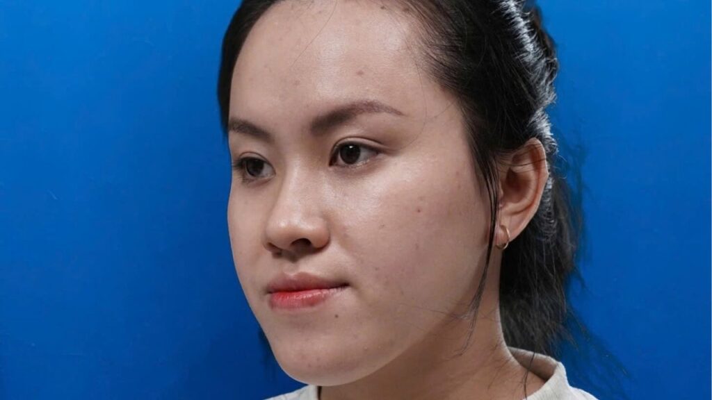 Móm xương có niềng được không? Giải pháp khắc phục ‘mặt lưỡi cày’ hiệu quả