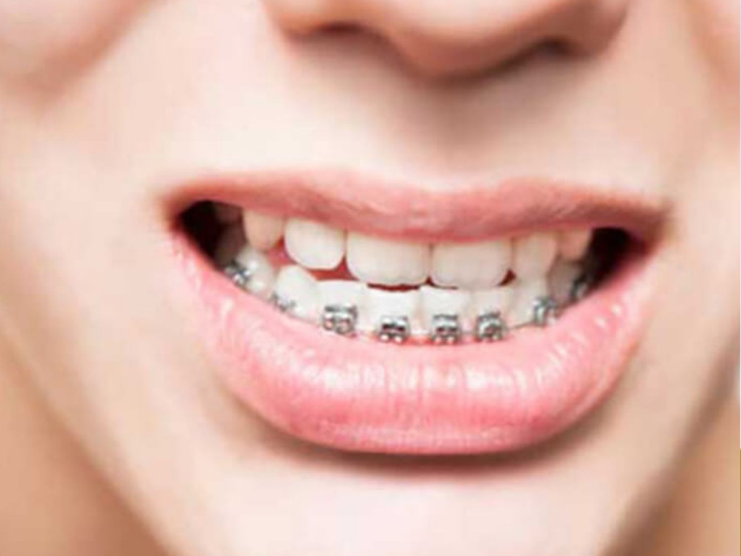 niềng răng trước khi chỉnh hàm 6-12 tháng