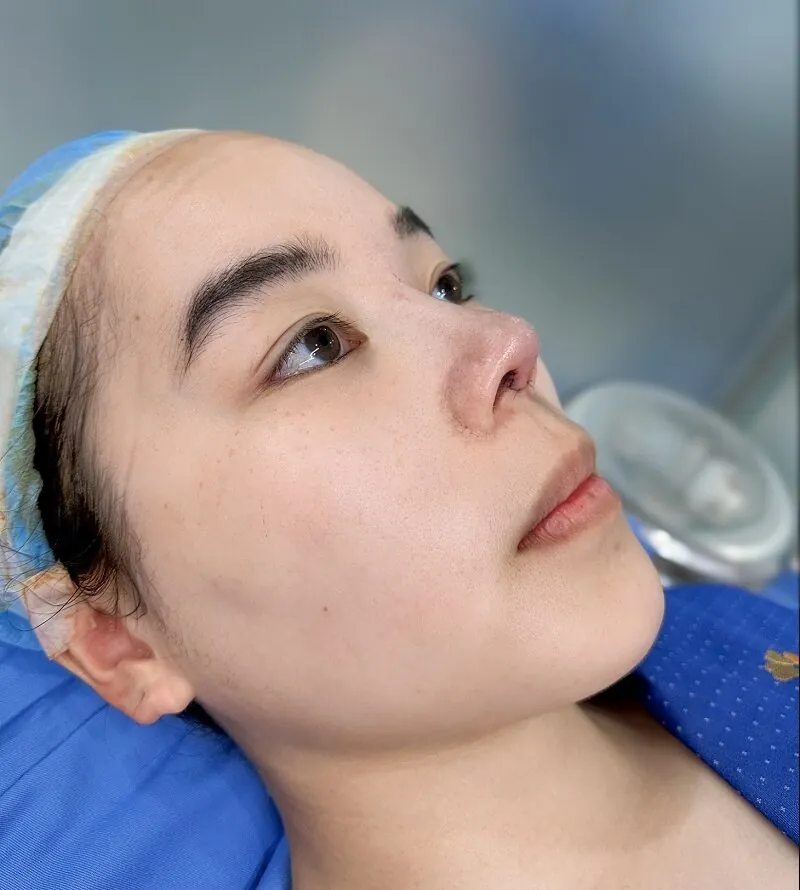 Thanh Thảo khi vừa nâng mũi xong, mũi đã lên dáng, cao hơn, nhưng vẫn còn sưng