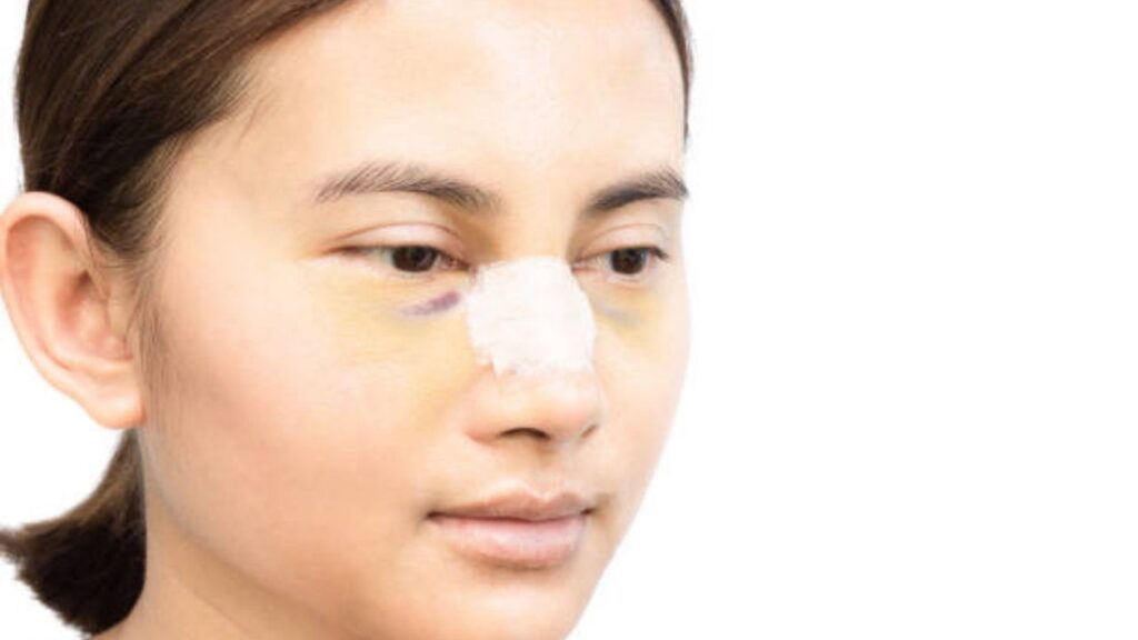 Nâng mũi có để lại sẹo không? Sự thật về kỹ thuật khâu vi phẫu và 4 yếu tố quyết định