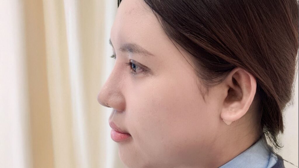 Review nâng mũi S-line 2026: Phân biệt bọc sụn và cấu trúc – Dáng mũi nào phù hợp với bạn