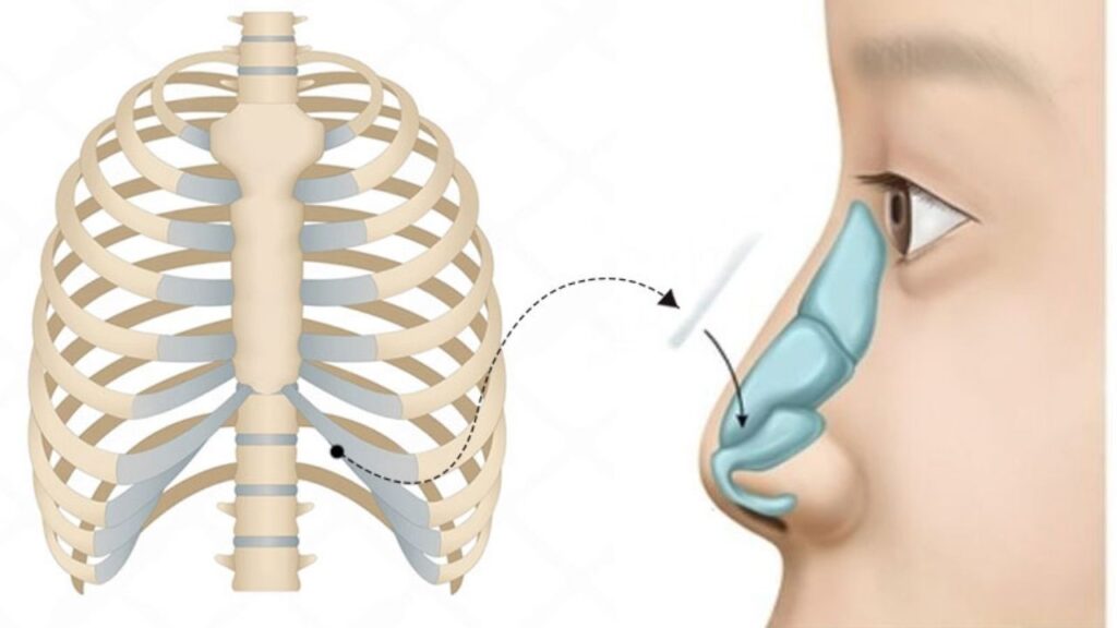 Nâng mũi sụn sườn là gì? Review ưu nhược điểm & 4 trường hợp bắt buộc sử dụng