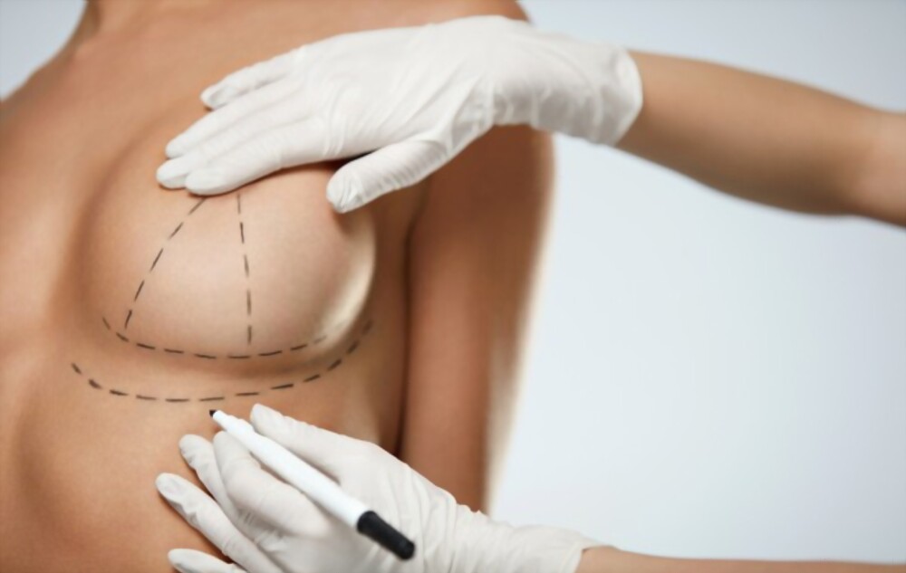 Đường mổ nâng ngực phù hợp sẽ được bác sĩ tư vấn cho khách hàng