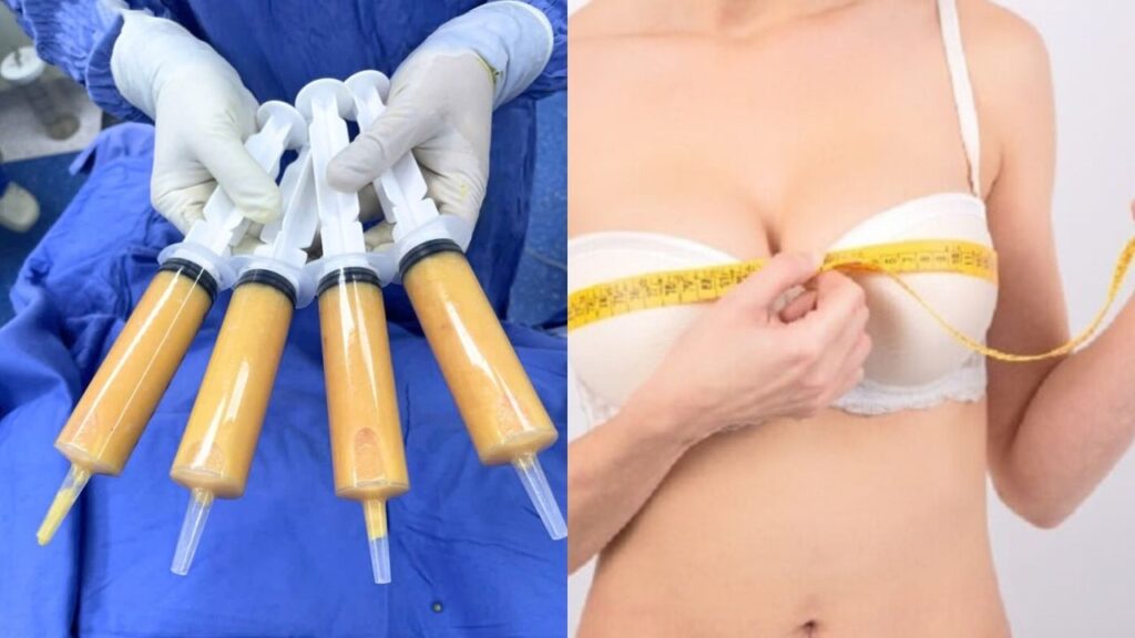 Nâng ngực bằng mỡ tự thân có bền không? 5 yếu tố quyết định tỷ lệ mỡ sống