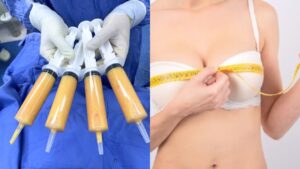 Nâng ngực bằng mỡ tự thân có bền không? 5 yếu tố quyết định tỷ lệ mỡ sống