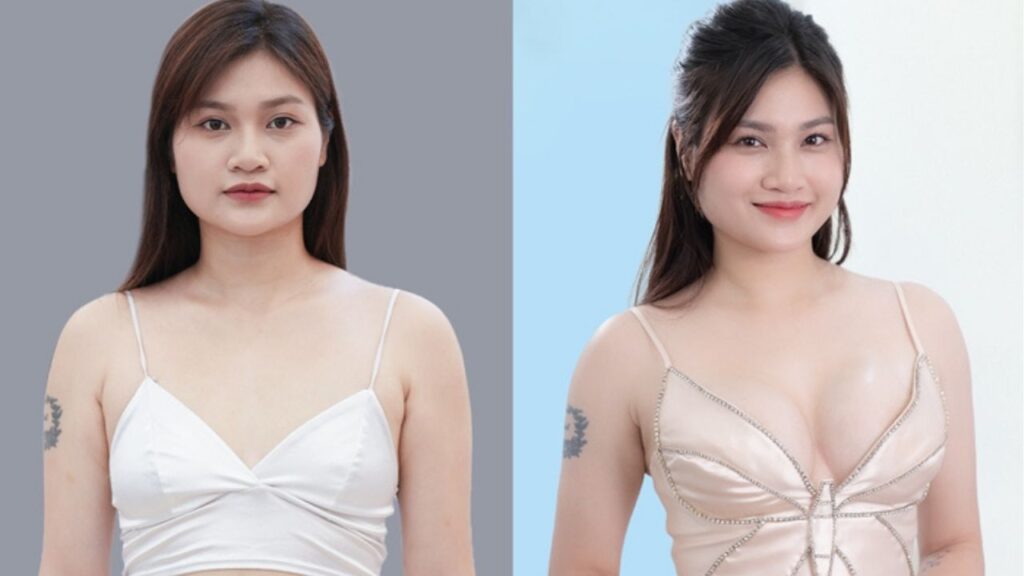 Nâng ngực bao lâu thì tự nhiên? Lộ trình 6 tháng để vòng 1 mềm mại như thật