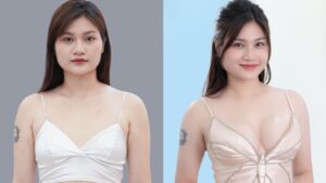 Nâng ngực bao lâu thì tự nhiên? Lộ trình 6 tháng để vòng 1 mềm mại như thật