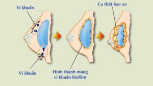 Nâng ngực bao xơ bao lâu thì xuất hiện? 4 cột mốc nguy cơ và dấu hiệu nhận biết sớm nhất