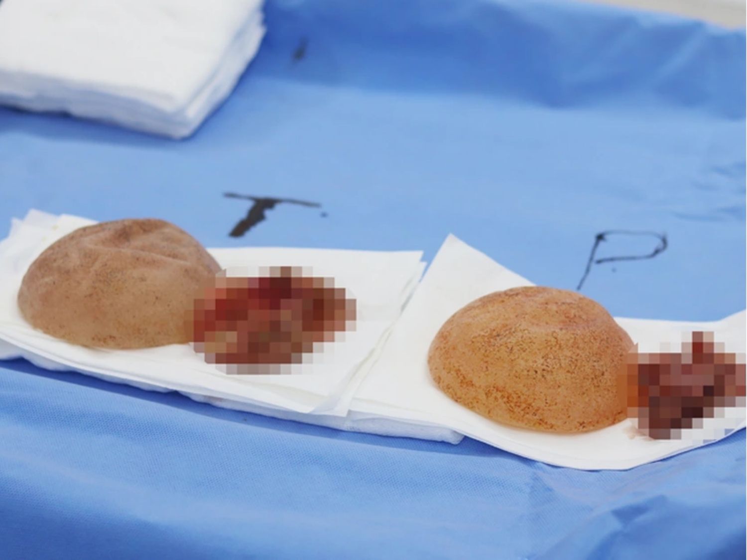 phẫu thuật nâng ngực không chính xác tăng nguy cơ bao xơ