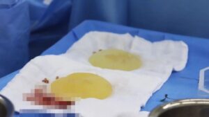 Nâng ngực bị bao xơ có sửa được không? Phân loại 4 mức độ và phác đồ điều trị triệt để