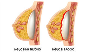 Nâng ngực bị bao xơ: Dấu hiệu & Phác đồ điều trị Baker III-IV