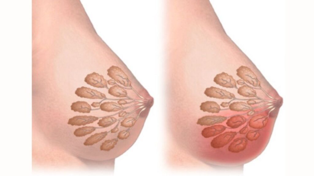 Nâng ngực bị hoại tử có sao không? Dấu hiệu & Cách xử lý khẩn cấp