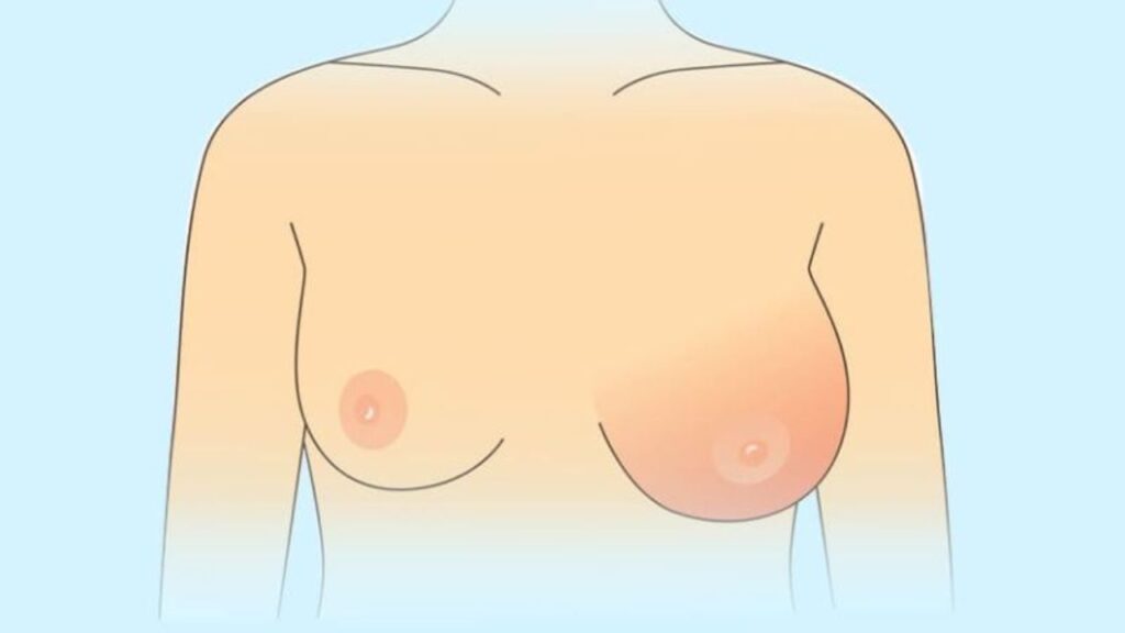 Nâng ngực có bị hoại tử không? Dấu hiệu nhận biết và cách phòng ngừa biến chứng