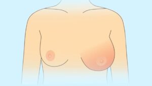 Nâng ngực có bị hoại tử không? Dấu hiệu nhận biết và cách phòng ngừa biến chứng