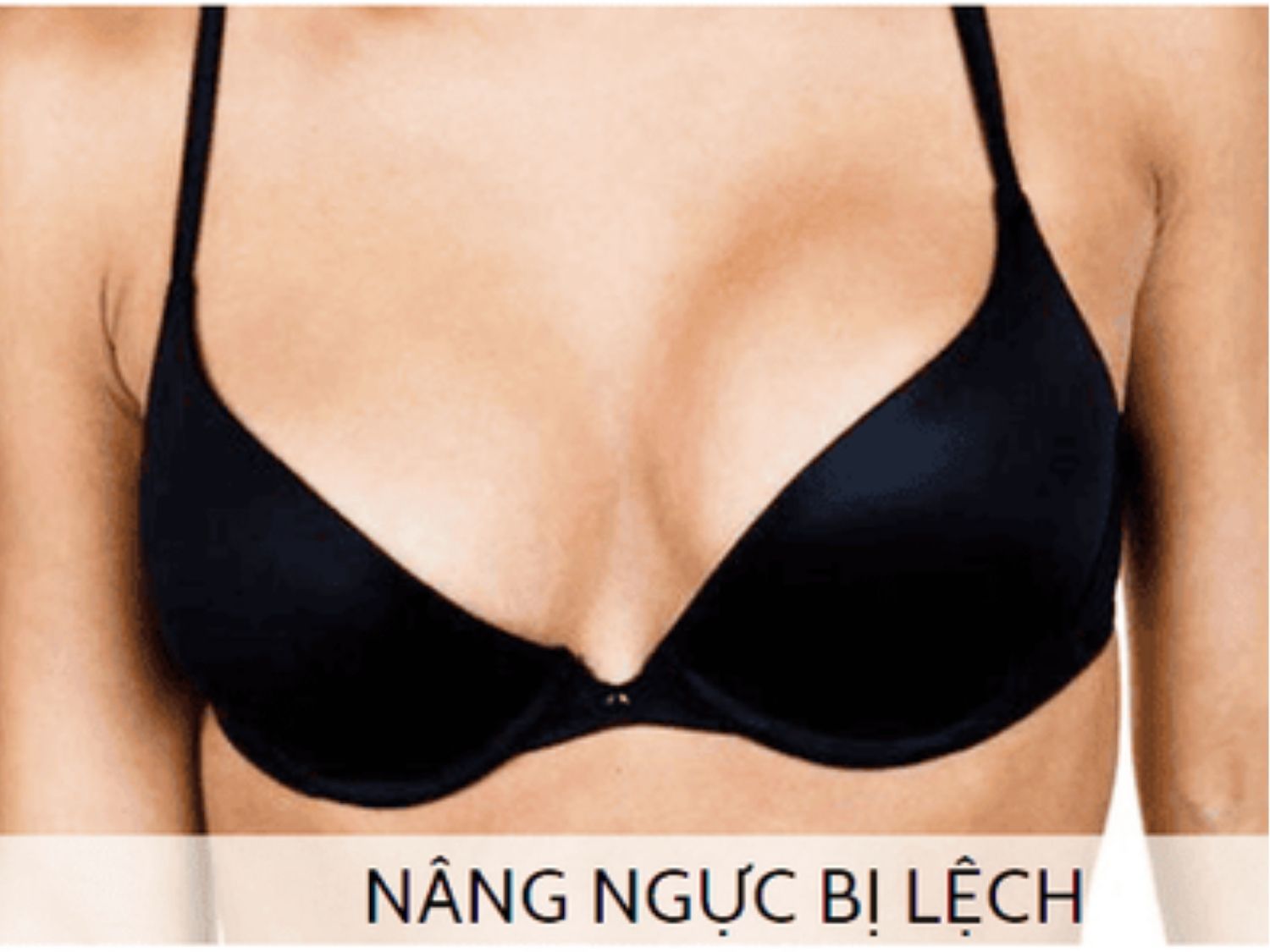 ngực lệch sau phẫu thuật do khách vận động mạnh quá sớm 